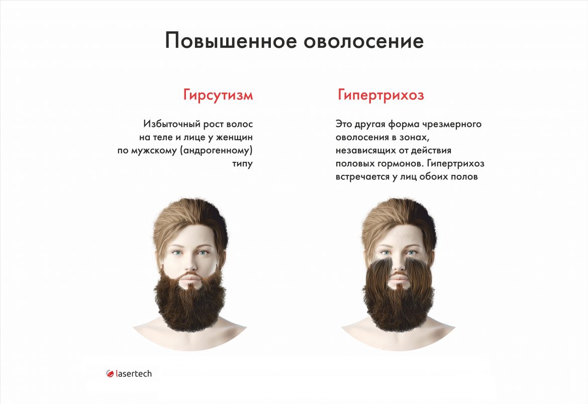 повышенное оволосение.jpg