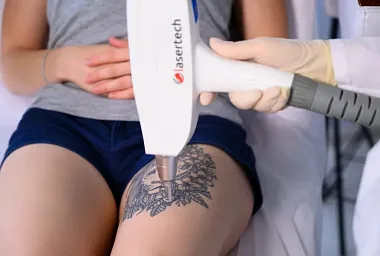 Удаление тату, что это такое и как на нем заработать?